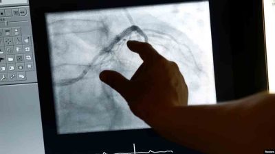 Rompi Berteknologi Tinggi Bantu Dokter Prediksi Serangan Jantung