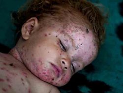 Penyakit Kulit Menimpa Anak-anak Gaza Seiring Perang yang Berlanjut Tanpa Akhir