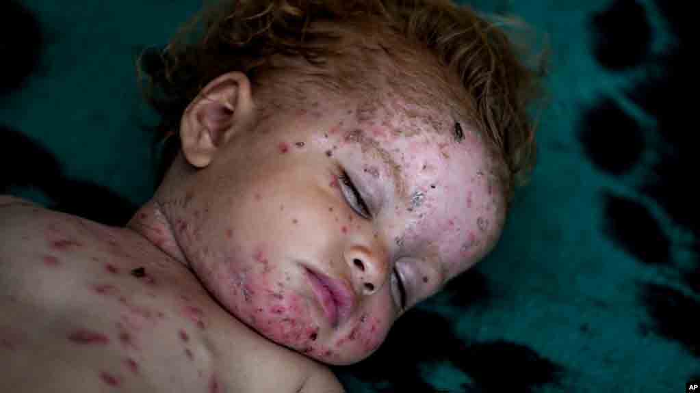 Penyakit Kulit Menimpa Anak Anak Gaza Seiring Perang Yang Berlanjut Tanpa Akhir